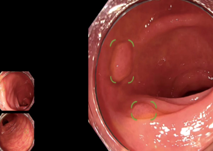 AI内視鏡システムEIRL導入で大腸腺腫(ポリープ)を早期発見